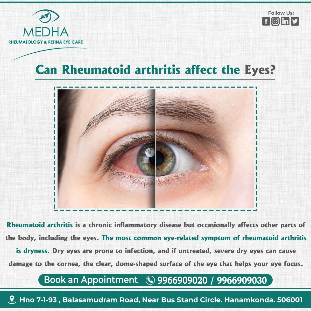 Can Rheumatoid Arthritis Affect The Eyes ?